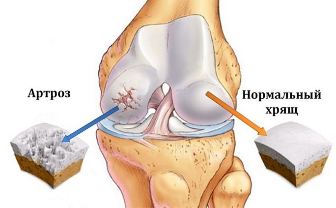 Изображение - Как лечить артроз коленного сустава в домашних kak-v-domashnix-usloviyax-lechit-artroz-kolennogo-sustava