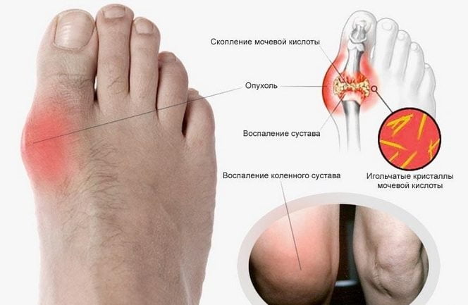питание при подагре ног что можно и что нельзя есть