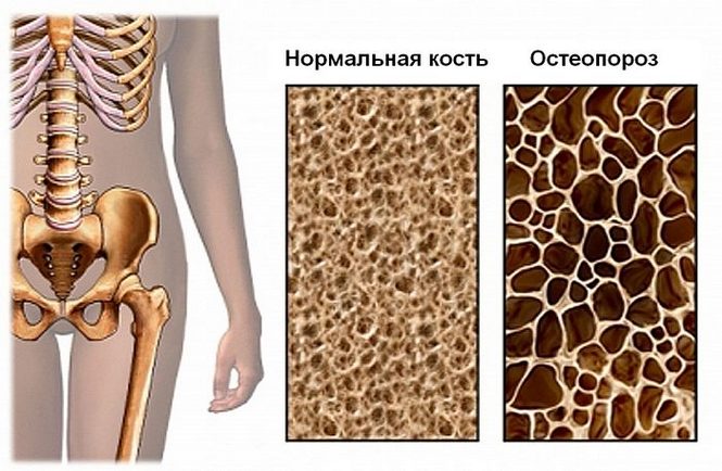 Остеопороз кости