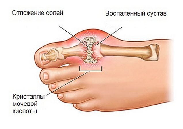 питание при подагре ног что можно и что нельзя есть