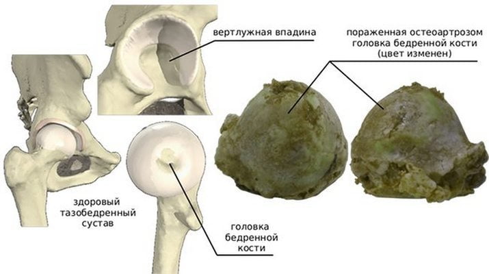 Болит нога в тазобедренном суставе при ходьбе