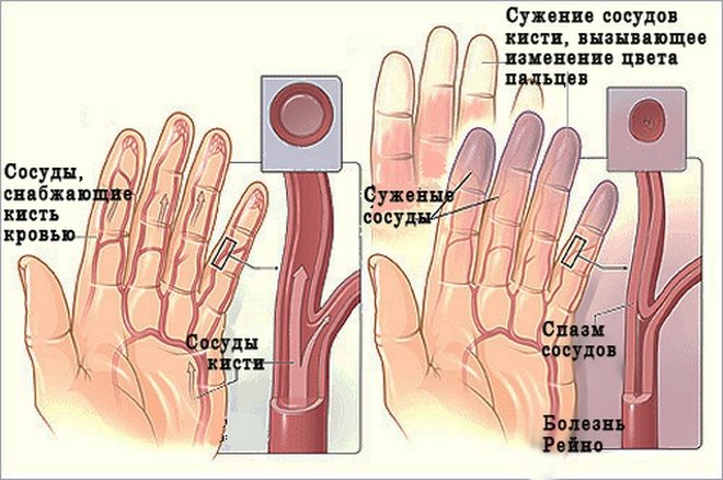 Болят суставы больших пальцев рук
