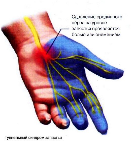 Туннельный сидром запястья