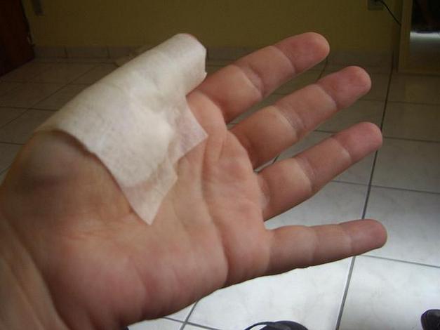 Травма большого пальца руки