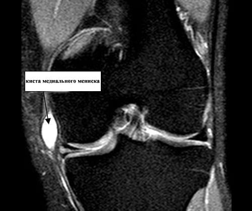 Костная киста коленного сустава лечение