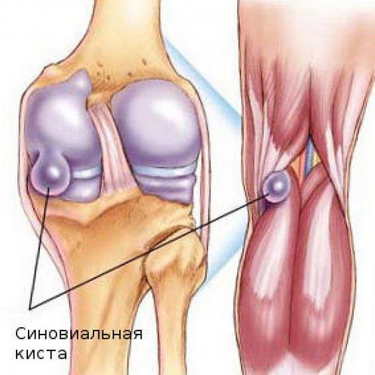 Изображение - Киста коленного сустава причины kista-v-kolennom-sustave