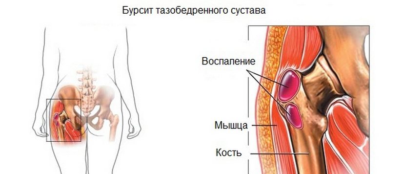 Изображение - Боли в тазобедренных суставах ночью лечение noyushhaya-bol-v-tazobedrennom-sustave-nochyu