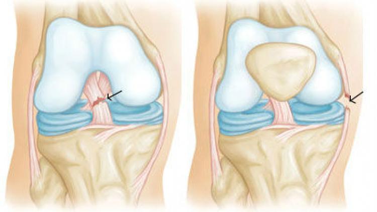Изображение - Разрыв крестообразной связки коленного сустава лечение 1311316498