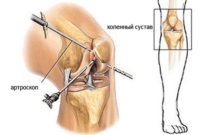Артроскопия коленного сустава что это