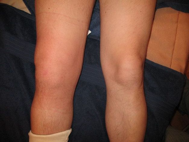 Изображение - Надрыв передней крестообразной связки коленного сустава лечение razryv-krestoobraznoj-svyazki