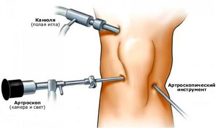 Изображение - Разрыв крестообразной связки коленного сустава лечение razryv-krestoobraznyx-svyazok