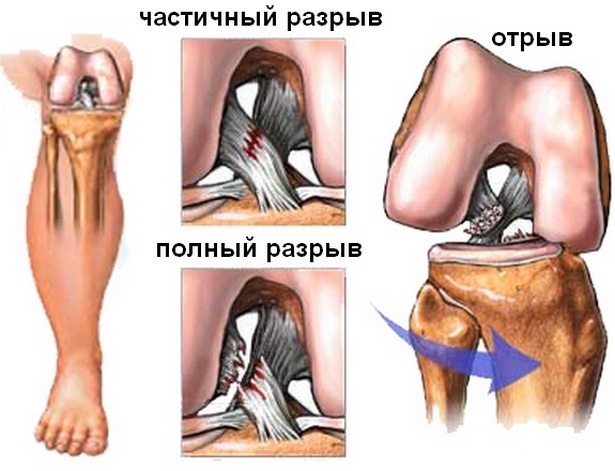 Разрыв передней крестообразной связки коленного сустава