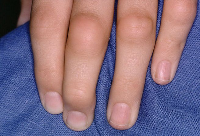 Ревматизм пальцев рук