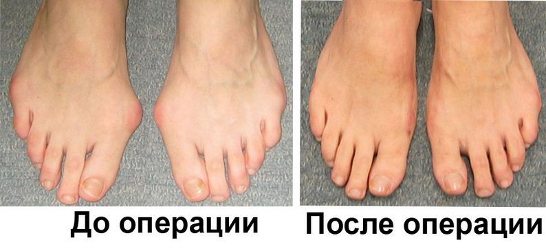 Хирургическое лечение косточки у большого пальца ноги