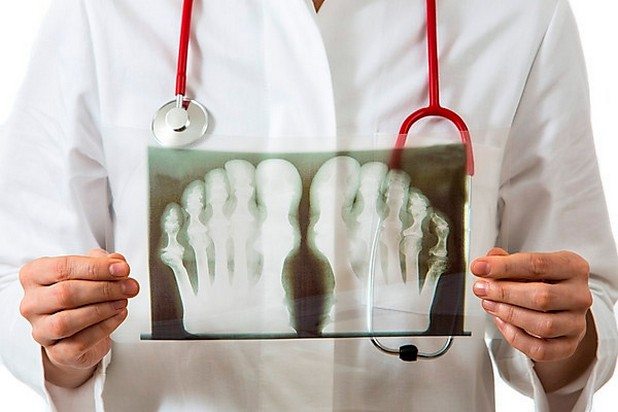 Рентгеновский снимок при подагрическом артрите
