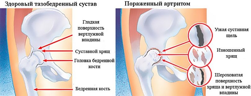 Пораженный артритом тазобедренный сустав