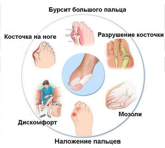Изображение - Болит сустав большого пальца на левой ноге Bol-v-sustave-bolshogo-palca-nogi