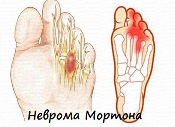 Изображение - Болит сустав большого пальца на левой ноге Bolit-bolshoj-palec-na-noge-pri-hodbe