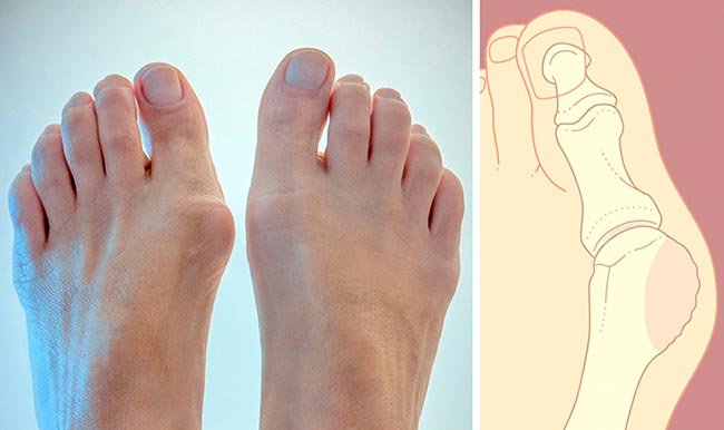 Изображение - Болит сустав большого пальца на левой ноге Bolit-sustav-bol-shogo-pal-ca-na-noge