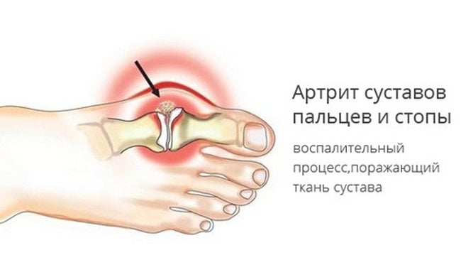 Изображение - Болит сустав большого пальца на левой ноге Bolit-sustav-bolshogo-palca-na-noge-chem-lechit