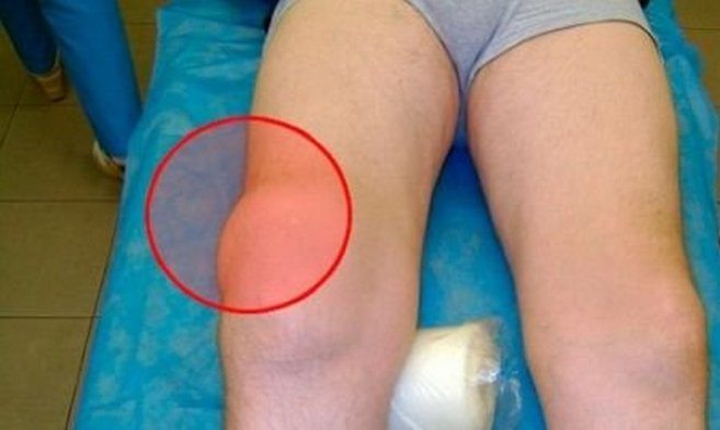 Изображение - Как лечить воспаление сухожилий коленного сустава Lechenie-tendinita-kolennogo-sustava