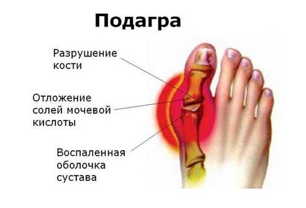 Изображение - Болит сустав большого пальца на левой ноге Pochemu-bolit-bolshoj-palec-na-noge