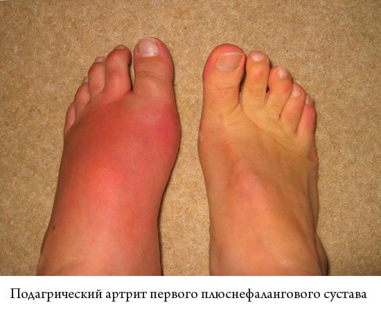Podagricheskij artrit stopy simptomy i lechenie foto