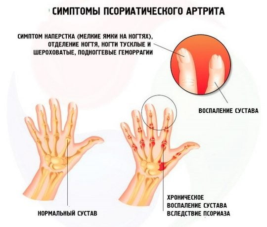 Симптомы псориатического артрита