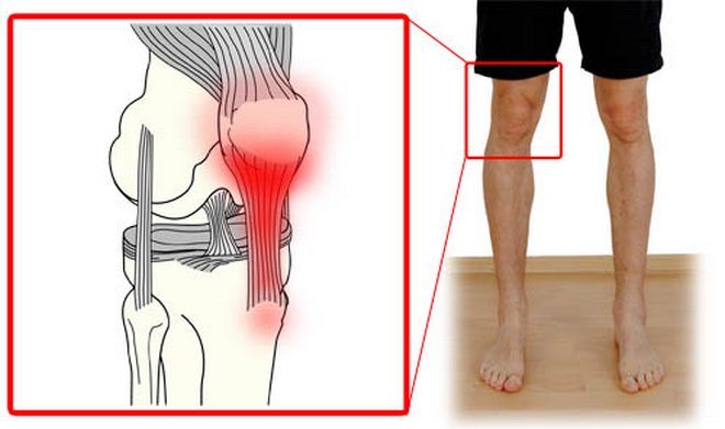 Воспаление сухожилия колена
