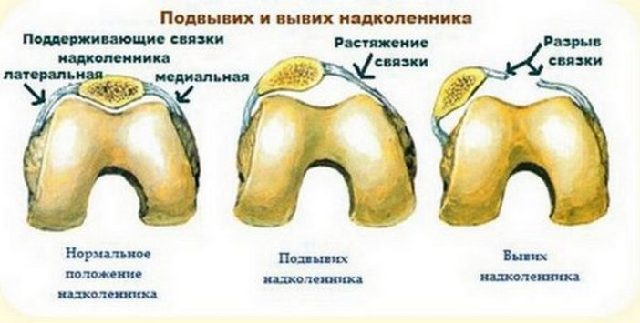Изображение - Как лечить вывих сустава podvyvih-kolennogo-sustava