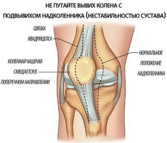 Изображение - Как лечить вывих сустава vyvih-kolennogo-sustava-simptomy