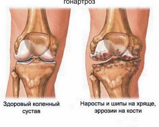Опухло колено артроз или артрит