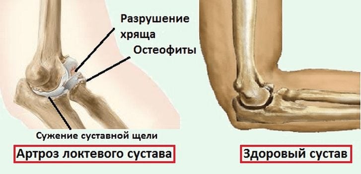 Изображение - Болит сустав руки при сгибании Bol-v-lokte-pri-sgibanii