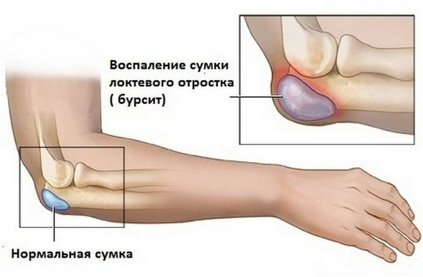 Изображение - Болит локоть в суставе при разгибании Bolit-ruka-v-lokte