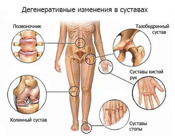 Изображение - Боли в мышцах и суставах причины Bluzhdayushhaya-bol-v-myshcah-i-sustavah
