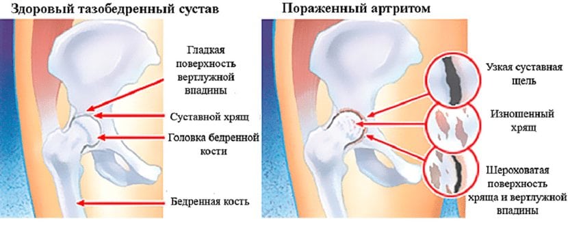 Пораженный артритом сустав