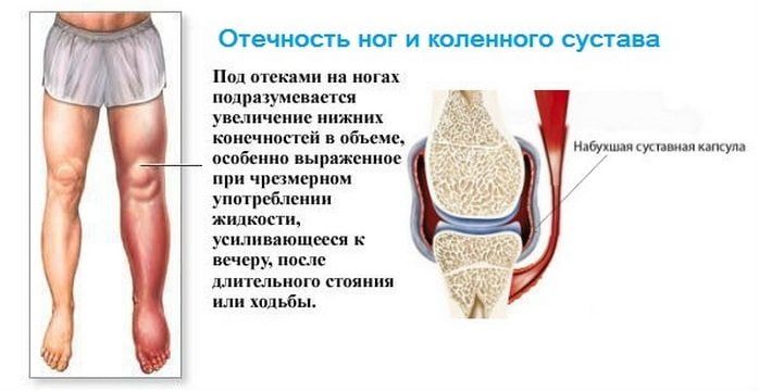 Деформирующий артроз коленного сустава 1 степени лечение
