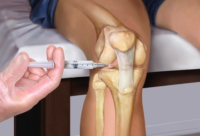 Уколы в коленный сустав при артрозе: препараты. Выбор, описание, инструкции