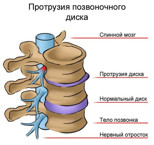 Изображение - Болит спина хрустят суставы Hrust-v-pozvonochnike-prichiny-i-lechenie