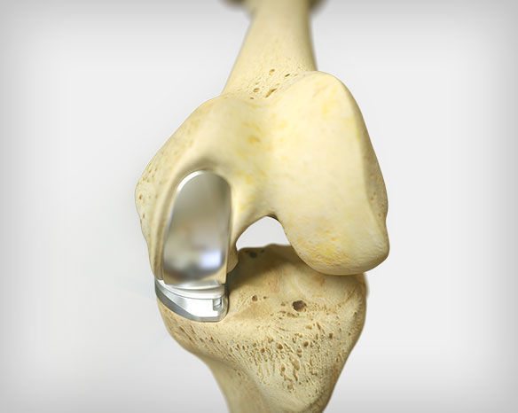 Стоимость операции артроза коленного сустава thumbnail
