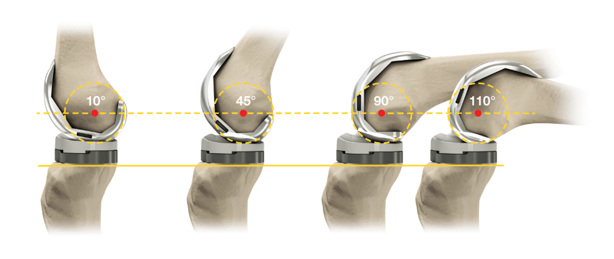 Почему колено после эндопротезирования. Stryker протез коленного сустава. Модульный эндопротез коленного сустава цито. Остеотомия коленного сустава. Эндопротезирование коленного Stryker.