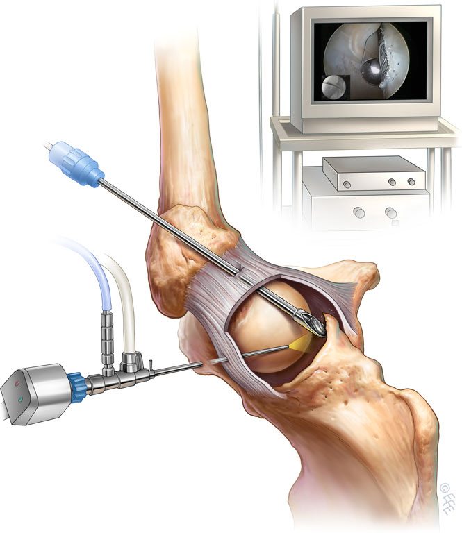 Операция на левый тазобедренный сустав thumbnail