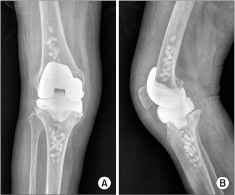 Восстановительное лечение после эндопротезирования коленного сустава