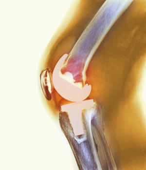 Изображение - Импланты связок коленного сустава цены %D0%B8%D0%BD%D1%84%D0%B5%D0%BA%D1%86%D0%B8%D1%8F