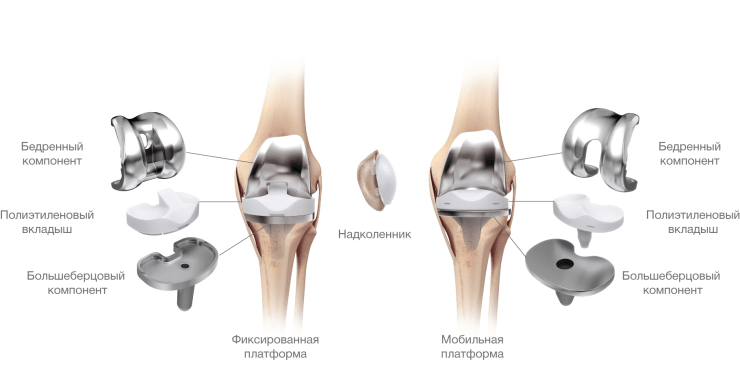 Полиартрит коленного сустава укол в сустав
