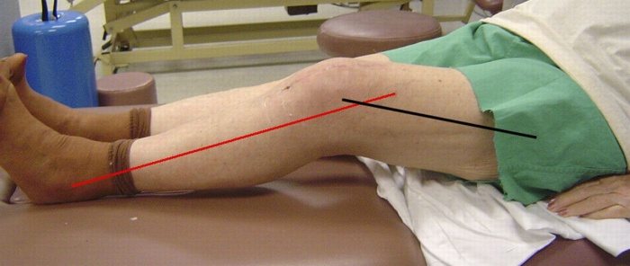 Болит шов после операции на коленном суставе