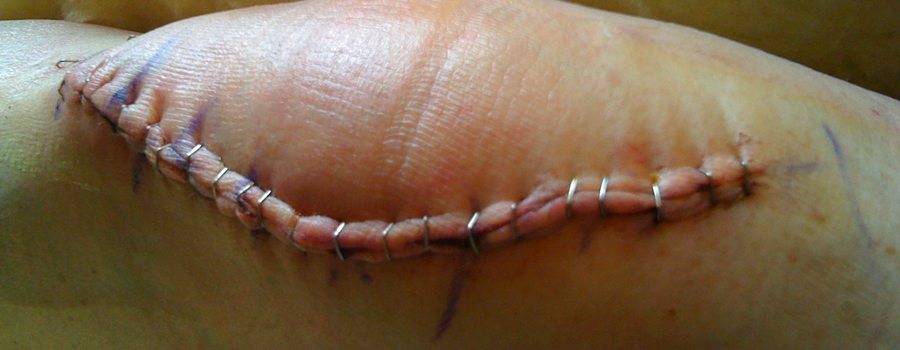 Артроз коленного сустава лечение цена операции thumbnail