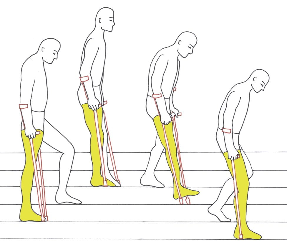 Реабилитация после замены коленного сустава