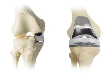 Тотальное эндопротезирование правого коленного сустава ход операции