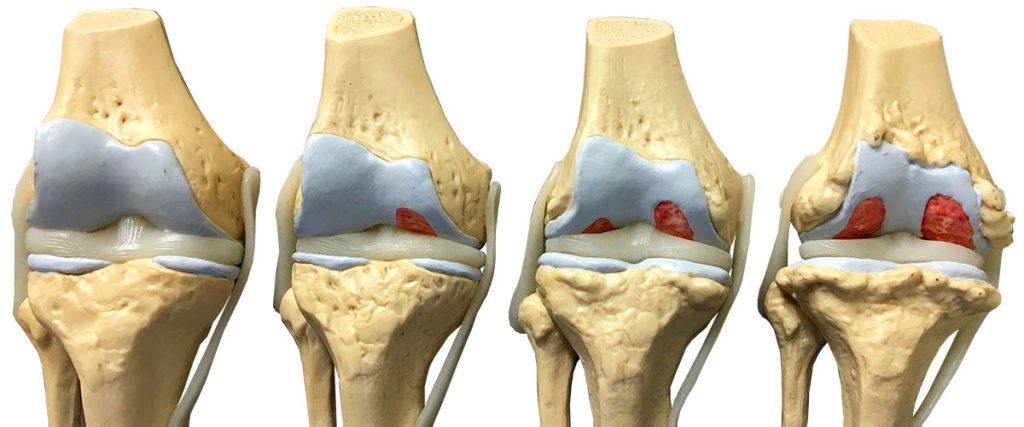 Эндопротезирование коленного сустава. Показания и операция по эндопротезированию коленного сустава. Реабилитация после эндопротезирования сустава